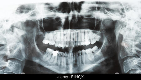 Kiefer dental Pantomogram Bild Stockfoto