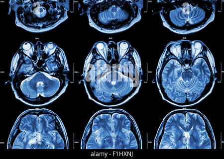 MRT des Gehirns (Querschnitt des Gehirns) (Medizin, Gesundheitswesen, Wissenschaft Hintergrund) Stockfoto