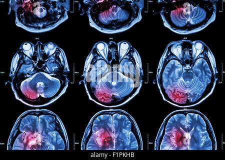 MRT (Magnet-Resonanz-Tomographie) des Gehirns zu Filmen (das MRT des Gehirns ist normale Gehirn aber roten Farbbereich ist künstlich für Qualitätssicherung Stockfoto