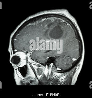 MRT des Gehirns mit Hirntumor (Sagittalebene, Seitenansicht, Seitenansicht) Film (Medizin, Gesundheitswesen, Wissenschaft) Stockfoto