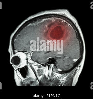 MRT des Gehirns mit Hirntumor (Sagittalebene, Seitenansicht, Seitenansicht) Film (Medizin, Gesundheitswesen, Wissenschaft) Stockfoto