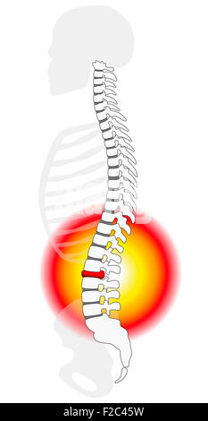 Bandscheibe Bandscheibenvorfall oder Prolaps bei einer menschlichen Wirbelsäule - Höhenplan. Stockfoto
