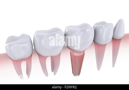 Molaren und Implantat in den Kieferknochen eingesetzt, 3d render Stockfoto