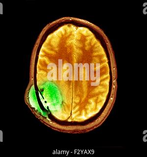 Gehirntumoren nach der Operation. Farbige Magnetresonanz-Bildgebung (MRI) Scan eines Abschnitts durch den Kopf eines 59 Jahre alten männlichen Patienten mit Glioblastoma Multiforme, zeigt einige Verbesserungen in der Erkrankung der weißen Substanz nach der Operation. Glioblastoma Multiforme ist eine maligne (bösartig) Tumor, der von Astrozyten, eines der Stützzellen des Gehirns entsteht. Es ist ein aggressiver Krebs mit einer schlechten Prognose. Hier hat sich die Krebs in den rechts Temporo-parietalen Hohlraum (unten rechts) weitgehend verbessert. Stockfoto