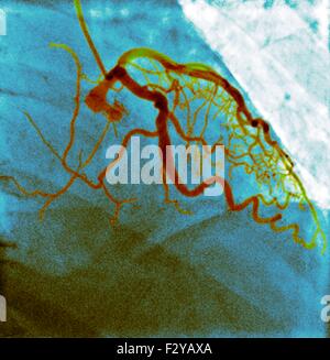 Normalen Blutgefäße. Farbig x-ray gesunde Blutgefäße in einem 80 Jahre alten Mann. Stockfoto