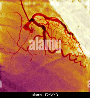 Normalen Blutgefäße. Farbig x-ray gesunde Blutgefäße in einem 80 Jahre alten Mann. Stockfoto