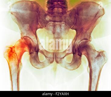 Hüfte vor Hüftoperation. Farbig x-ray einen Schnitt durch die Becken-Region von einem 66 Jahre alten männlichen Patienten mit eine beschädigte Hüftgelenk (links), die vor dem Hüftewiedereinbauchirurgie. Stockfoto