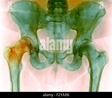 Hüfte vor Hüftoperation. Farbig x-ray einen Schnitt durch die Becken-Region von einem 66 Jahre alten männlichen Patienten mit eine beschädigte Hüftgelenk (links), die vor dem Hüftewiedereinbauchirurgie. Stockfoto