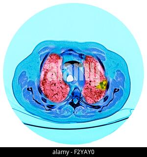 Lungenkrebs. Farbige Computertomographie (CT) Untersuchung des einen Schnitt durch die Brust eines 76 Jahre alten männlichen Patienten mit einem malignen (bösartig) Tumor (hell, nicht wahr) von der Bronchus. Die Bronchien sind die Atemwege, die Luft in die Lungen und den Mund zu tragen. Stockfoto