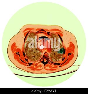 Lungenkrebs. Farbige Computertomographie (CT) Untersuchung des einen Schnitt durch die Brust ein 76 Jahre alten männlichen Patienten mit einem malignen (bösartig) Tumor (dunkel, rechts) von der Bronchus. Die Bronchien sind die Atemwege, die Luft in die Lungen und den Mund zu tragen. Stockfoto