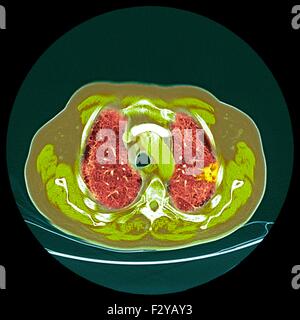 Lungenkrebs. Farbige Computertomographie (CT) Untersuchung des einen Schnitt durch die Brust eines 76 Jahre alten männlichen Patienten mit einem malignen (bösartig) Tumor (hell, nicht wahr) von der Bronchus. Die Bronchien sind die Atemwege, die Luft in die Lungen und den Mund zu tragen. Stockfoto
