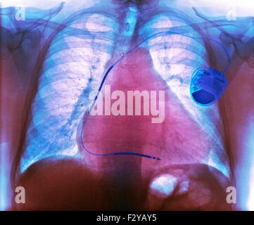 Herzschrittmacher bei Herzkrankheiten. Farbige Röntgenaufnahme zeigt einen Herzschrittmacher (rechts) ausgestattet, um einen 73 Jahre alten männlichen Patienten mit chronisch obstruktiver Lungenerkrankung (COPD), ein vergrößertes Herz (Kardiomegalie) Vorhofflimmern und ischämische Herzkrankheit. Ein Herzschrittmacher liefert elektrische Impulse zum Herzen, den Herzschlag zu einem regelmäßigen Preis beizubehalten. Es kann externe (am Gürtel getragen) oder internen (implantiert in der Brust, als hier). Stockfoto