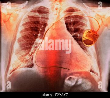 Herzschrittmacher bei Herzkrankheiten. Farbige Röntgenaufnahme zeigt einen Herzschrittmacher (rechts) ausgestattet, um einen 73 Jahre alten männlichen Patienten mit chronisch obstruktiver Lungenerkrankung (COPD), ein vergrößertes Herz (Kardiomegalie) Vorhofflimmern und ischämische Herzkrankheit. Ein Herzschrittmacher liefert elektrische Impulse zum Herzen, den Herzschlag zu einem regelmäßigen Preis beizubehalten. Es kann externe (am Gürtel getragen) oder internen (implantiert in der Brust, als hier). Stockfoto