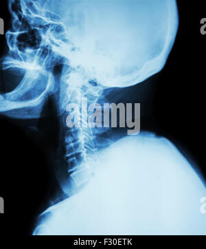 Zervikale Spondylose.  Film-Röntgen der Halswirbelsäule (Seitenlage) (Seitenansicht) Stockfoto