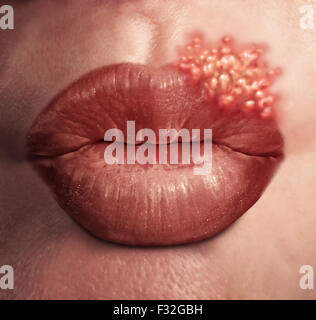 Lippenherpes Herpes Virus medizinisches Konzept als menschlichen Lippen mit einem Ausbruch von geschwollenen Fieberblasen als eine Infektion auf der Haut. Stockfoto