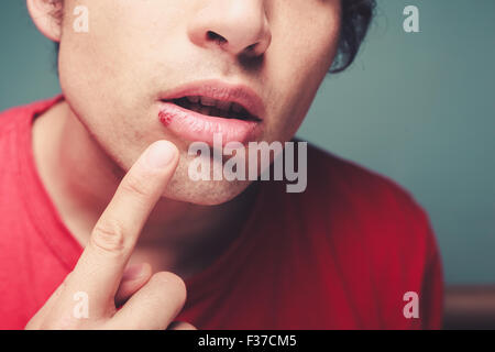 Junger Mann zeigt seine Lippe ein Herpesbläschen Stockfoto