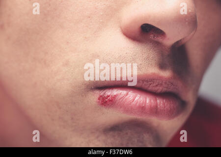 Junger Mann mit ein Herpesbläschen auf der Lippe Stockfoto