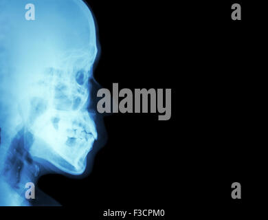 Film x-ray seitliche Nasenbein (Seitenansicht des Schädels) und leeren Bereich auf der rechten Seite Stockfoto