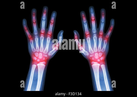 Rheumatoide Arthritis, Gicht-Arthritis (Film Röntgen beider Hände des Kindes mit mehreren Gelenkarthrose) (Medizin, Wissenschaft und Stockfoto