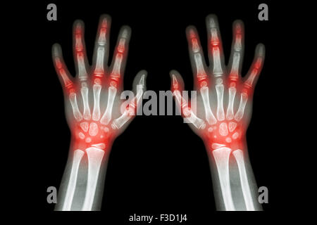 Rheumatoide Arthritis, Gicht-Arthritis (Film Röntgen beider Hände des Kindes mit mehreren Gelenkarthrose) (Medizin, Wissenschaft und Stockfoto