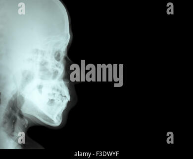 Film x-ray seitliche Nasenbein (Seitenansicht des Schädels) und leeren Bereich auf der rechten Seite Stockfoto