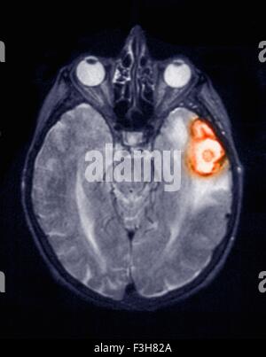 Temporoparietal Gehirnblutung in eine 77 Jahre alte Frau auf eine MRT-Untersuchung gezeigt Stockfoto