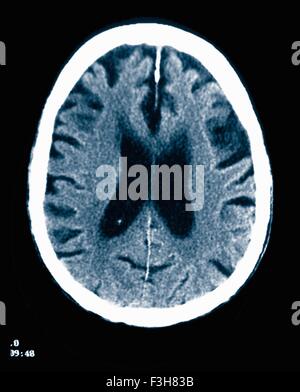 CT-Scan 84 Jahre alter Mann mit Alzheimer-Krankheit.  CT zeigt Hirnatrophie mit kleinen Windungen und großen Furchen Stockfoto
