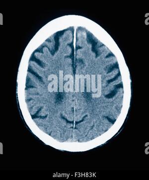 CT-Scan 84 Jahre alter Mann mit Alzheimer-Krankheit.  CT zeigt Hirnatrophie mit kleinen Windungen und großen Furchen Stockfoto