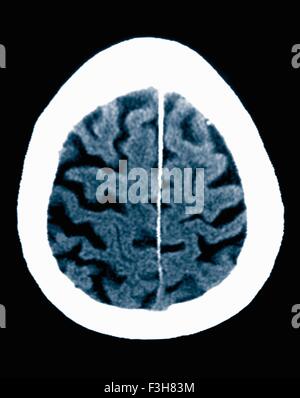 CT-Scan 84 Jahre alter Mann mit Alzheimer-Krankheit.  CT zeigt Hirnatrophie mit kleinen Windungen und großen Furchen Stockfoto