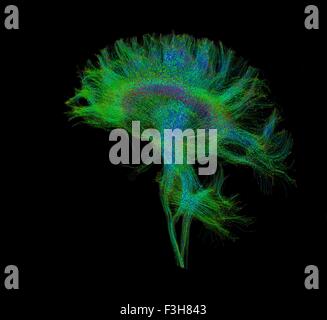 Verbreitung MRI, auch bezeichnet als Diffusion Tensor Imaging oder DTI, des menschlichen Gehirns Stockfoto