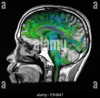 Verbreitung MRI, auch bezeichnet als Diffusion Tensor Imaging oder DTI, des menschlichen Gehirns Stockfoto