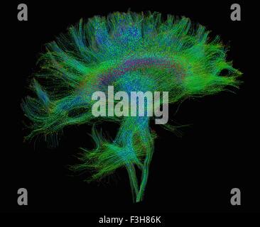 Verbreitung MRI, auch bezeichnet als Diffusion Tensor Imaging oder DTI, des menschlichen Gehirns Stockfoto