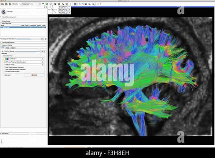 Verbreitung MRI, auch bezeichnet als Diffusion Tensor Imaging oder DTI, des menschlichen Gehirns Stockfoto