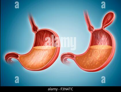 Magen mit und ohne Hernie Stockfoto