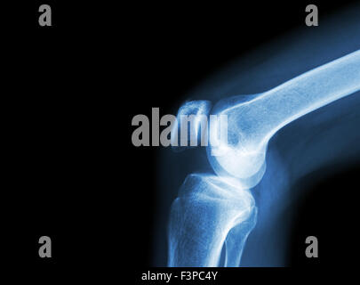 Film x-ray Kniegelenk bei Arthritis (Gicht, rheumatoide Arthritis, septische Arthritis, Arthrose Knie) und leeren Bereich im Stockfoto