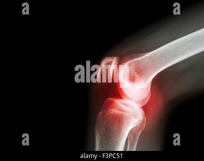 Film x-ray Kniegelenk bei Arthritis (Gicht, rheumatoide Arthritis, septische Arthritis, Arthrose Knie) und leeren Bereich im Stockfoto