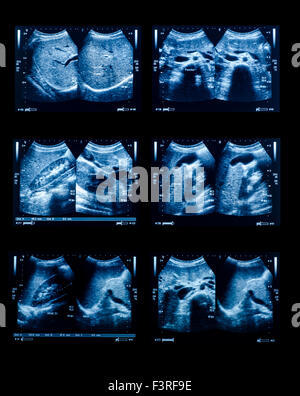 Sonographie Oberbauch ärztliche Untersuchung für das Gesundheitswesen Stockfoto