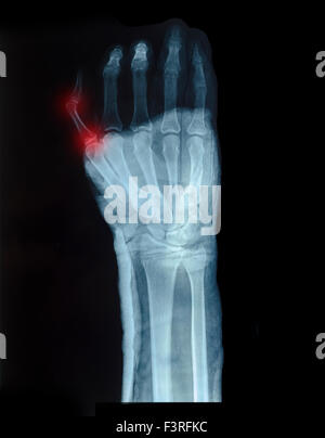 Röntgenbild der menschlichen Hand mit kleinen Fingern gezeigt rot für Fraktur Stockfoto