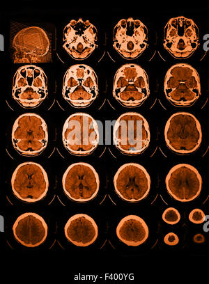 Foto von der CT und MRT des Schädels Stockfoto
