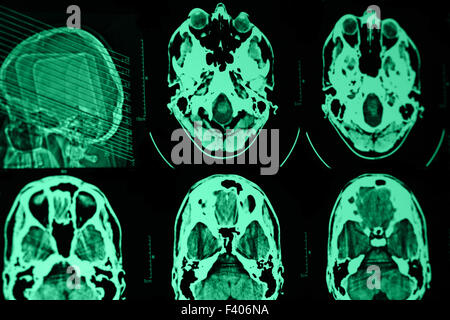 Foto von der CT und MRT des Schädels Stockfoto