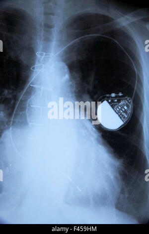 Eine Röntgenaufnahme eines 75-Jahr-alten Mannes zeigt einen Herzschrittmacher. Beachten Sie die lange elektrische "führen." Der Schrittmacher ist ein Medizinprodukt, das elektrische Impulse, geliefert durch Elektroden, die Auftraggeber der Herzmuskels verwendet, um den Herzschlag zu regulieren. Stockfoto