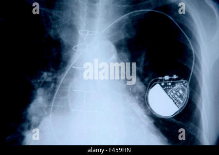 Eine Röntgenaufnahme eines 75-Jahr-alten Mannes zeigt einen Herzschrittmacher. Beachten Sie die lange elektrische "führen." Der Schrittmacher ist ein Medizinprodukt, das elektrische Impulse, geliefert durch Elektroden, die Auftraggeber der Herzmuskels verwendet, um den Herzschlag zu regulieren. Stockfoto