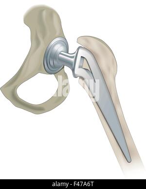 Ein Vektorbild einen Ersatz-Hüftgelenk, künstliches Gelenk Stock Vektor