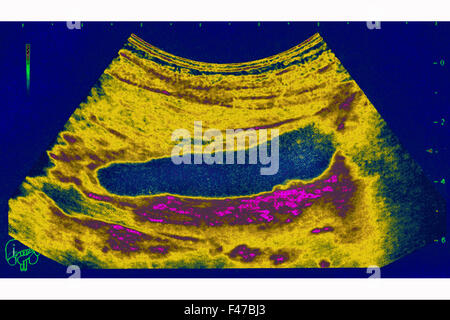 CHOLEZYSTITIS ULTRASCHALL Stockfoto, Bild: 88673261 - Alamy