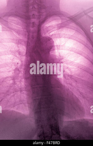 ATHEROMATOUS AORTA, X-RAY Stockfoto