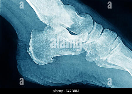 ENTHESOPATHY X-RAY Stockfoto