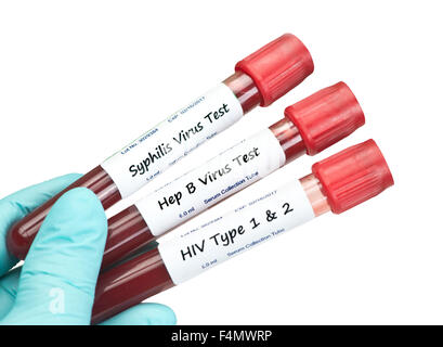 Syphilis, HIV und Hepatitis B Virus Probe Blutentnahmeröhrchen durch Techniker statt. Stockfoto