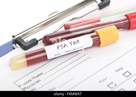 Prostata-spezifisches Antigen PSA Blut Kultur Sammlung Probenröhrchen mit Patientenakte. Stockfoto