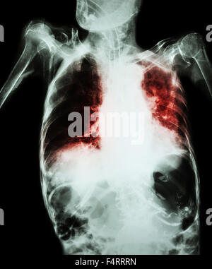 Lungentuberkulose mit akute respiratorische Insuffizienz (Film Röntgen-Thorax des alten Patienten zeigen alveoläre und interstitielle infiltrat Stockfoto