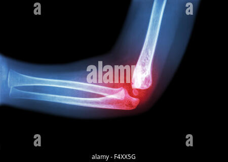 Rheumatoide Arthritis, Gicht-Arthritis (Film Röntgen Kind Ellenbogen mit Arthritis am Ellenbogen) (Seitenansicht, Lateral) Stockfoto